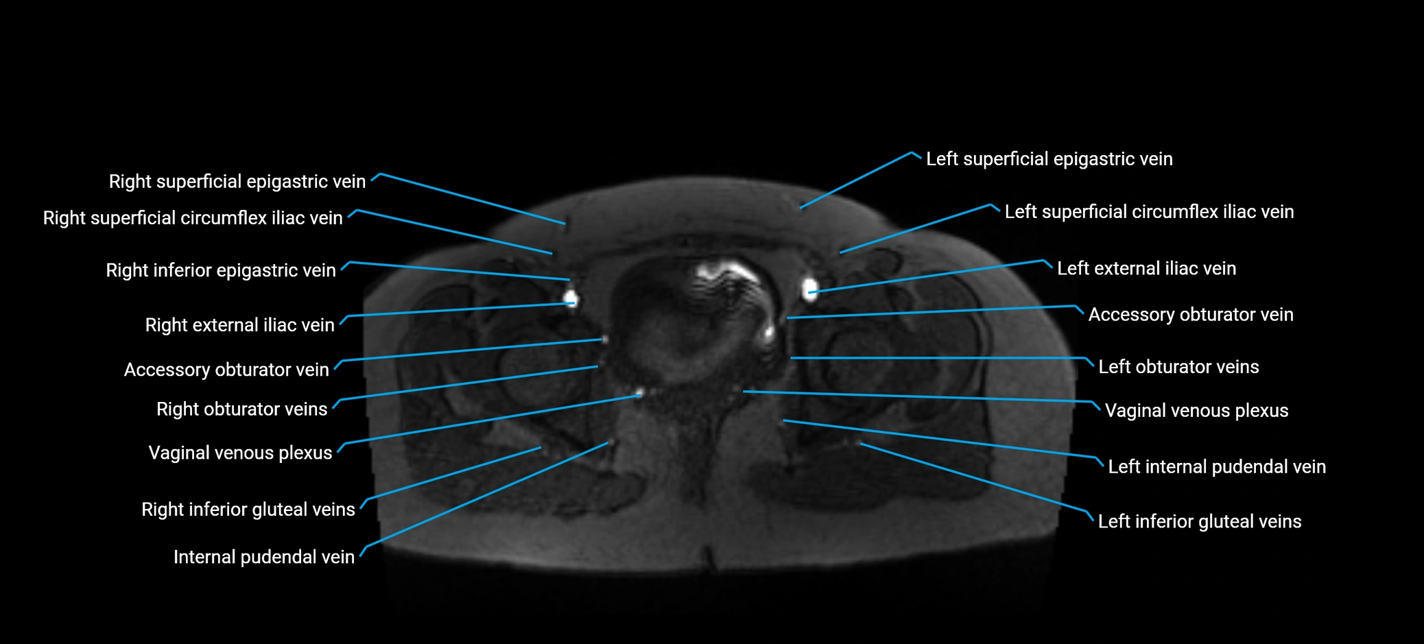 MRV abdomen pelvis & lower limb axial cross sectional anatomy labelled MRI image 180 (1).webp
